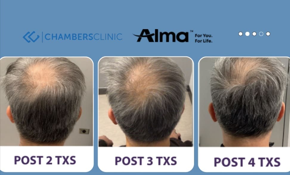 Hair Growth. Chambers Clinic IG