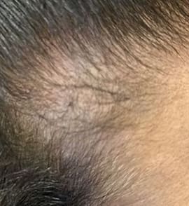 Hair line hair loss. Photo courtesy of Alma Inc