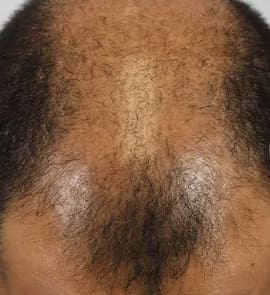Hair loss. Photo courtesy of Alma Inc.